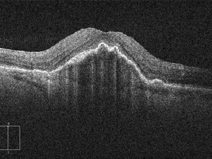 Vascularized Pigment Epithelial Detachment