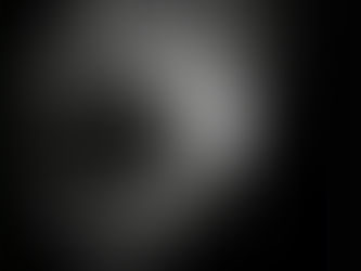 Dark choroidal sign / Stargardt disease