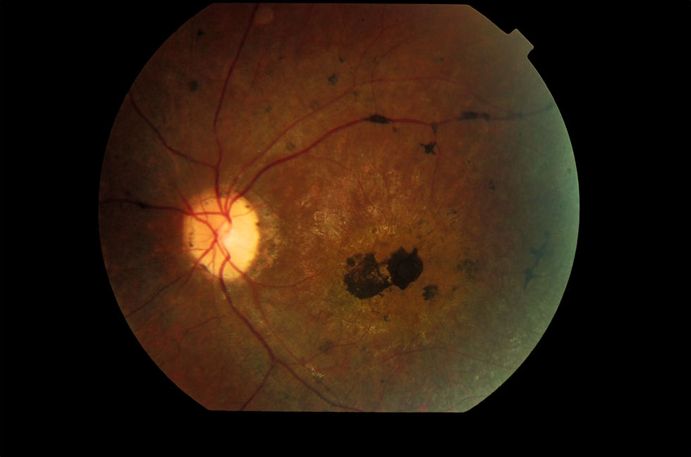 tapetoretinal degeneration
