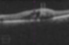 Intraretinal hemorrhage due to vascular occlusion