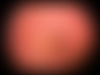 Best vitelliform macular dystrophy