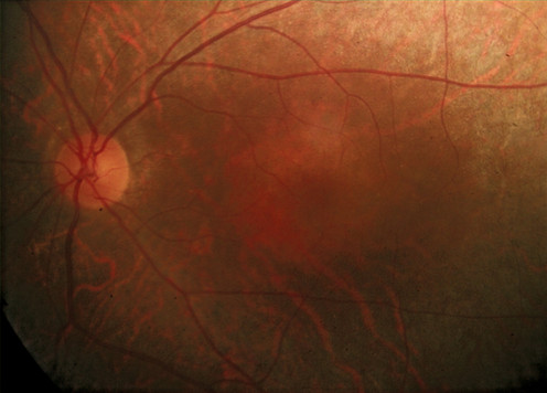 phy, macular photoreceptor atrophy