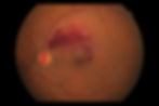 retinal vascular disease