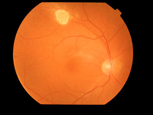 Retinal Astrocytic Hamartoma