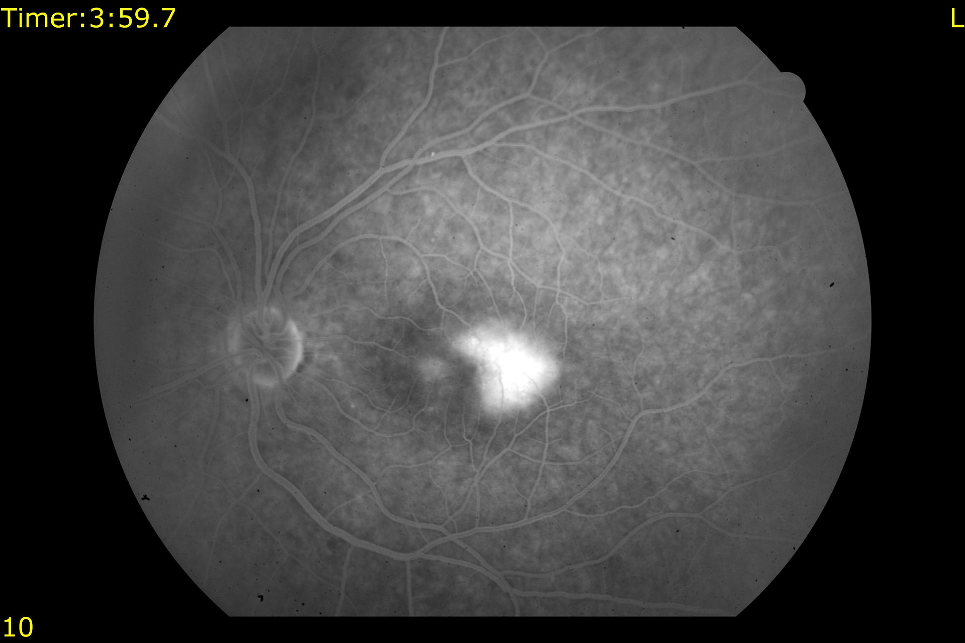 macular telengiectasis