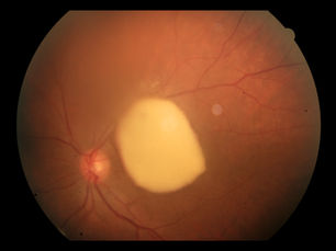 Dehemoglobinized Sub-hyaloid Hemorrhage / Valsalva Retinopathy