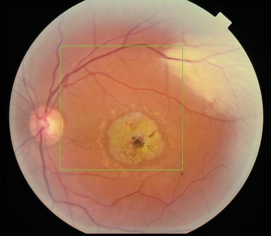 Fundus Flavimaculatus Fundus Flavimaculatus