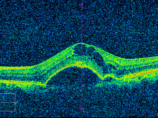 Retinal Angiomatous Proliferation (RAP)