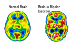 What Causes Bipolar Disorder in the Brain?