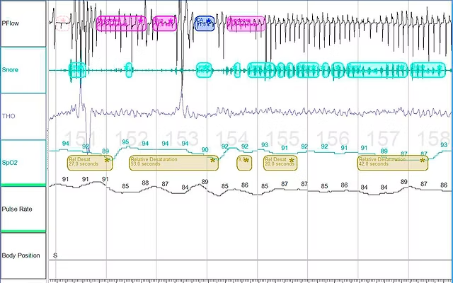 Tak może wyglądać analiza fragmentaryczna snu w trakcie badania polisomnograficznego.
