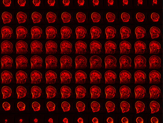 Your MRI Report: What Does It All Mean? What Now?