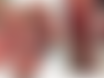 SINDROME DE KAWASAKI - COVID19. Post 2.