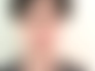 SÍNDROME DE RADIO TARTAGLIA 