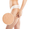 A woman after weight loss shows stretch marks on the skin of her legs and the outer and in