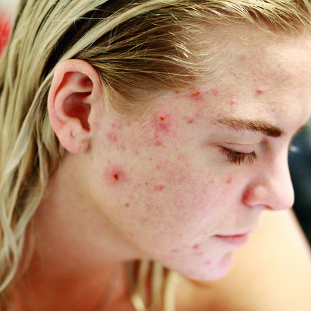 Unveiling the Origins: Understanding Acne Scar Formation