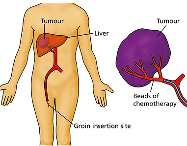trans arterial chemoembolization Nairobi