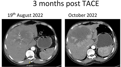 Image from slide presentation at Kenya Association of Radiologist 2024 annual scientific conference showing first DEBTACE
