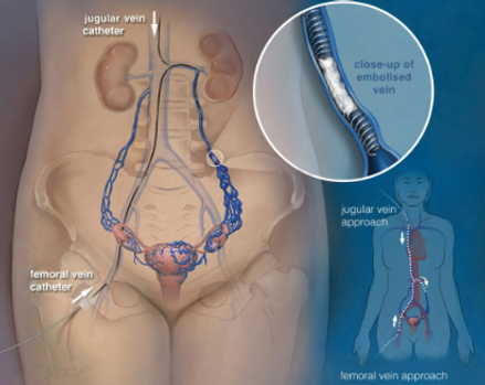 Pelvic congestion syndrome nairobi