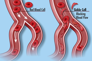 What is Sickle Cell Disease
