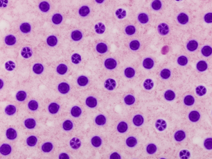 Anaplasmosis Infections Climbing in New York at Alarming Rate