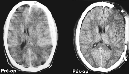 craniotomia descompressiva