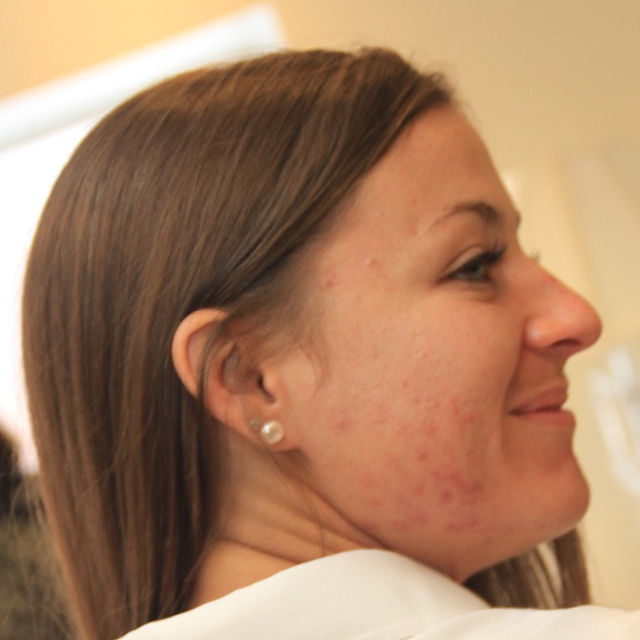Acne Pic 2_edited_edited