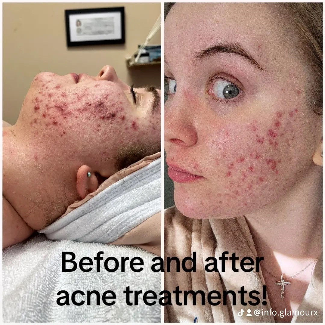 Acne facial results