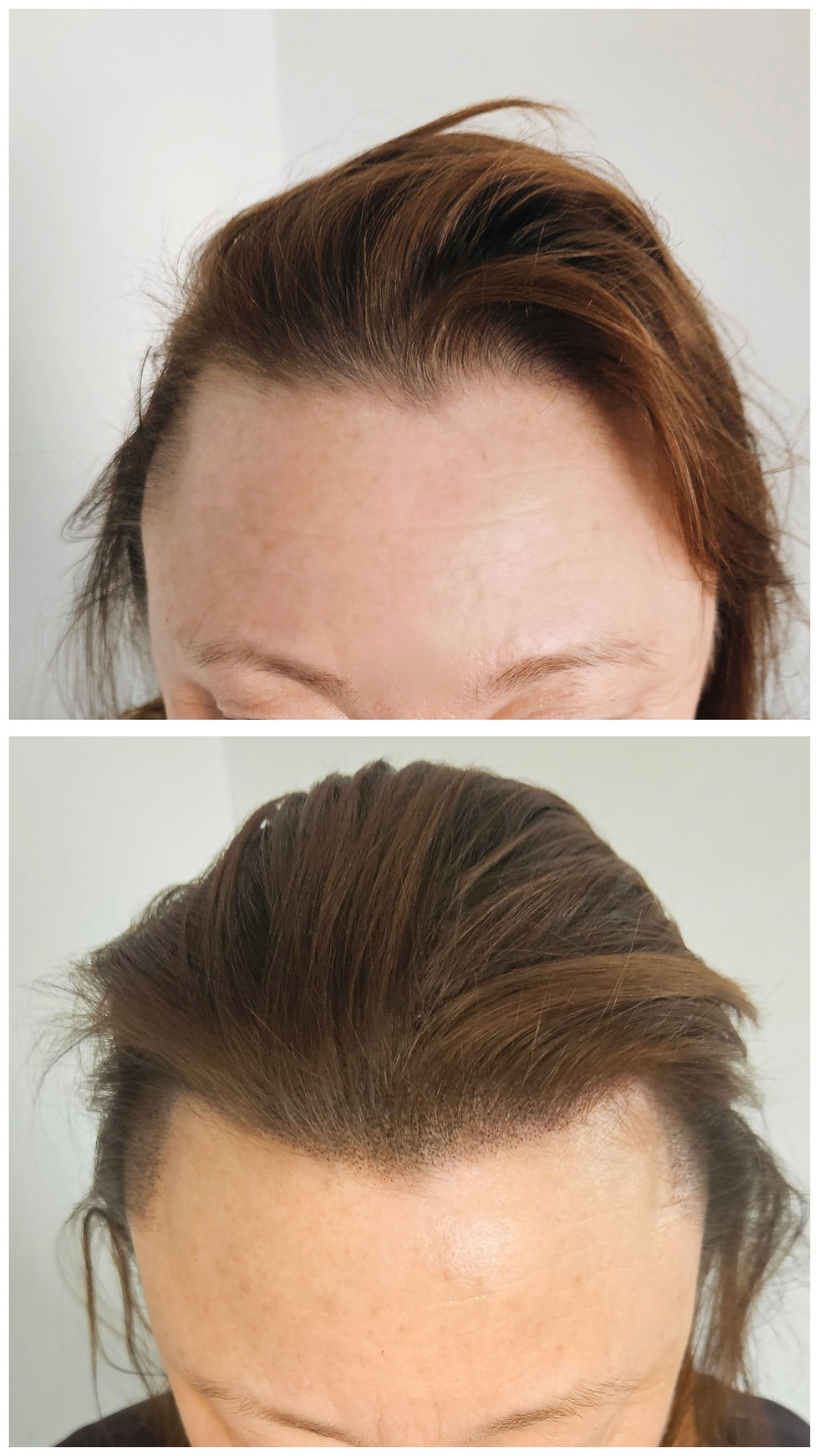 Close-up view of a practitioner preparing a scalp micropigmentation treatment on a woman with thinning hair.
