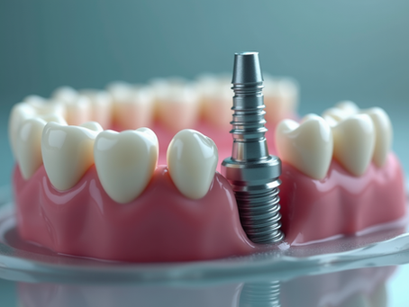 Protesi su impianti: guida alla fase protesica dopo la chirurgia implantare