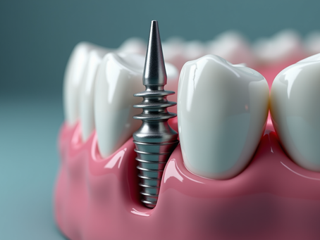 Il processo di osteointegrazione degli impianti dentali: cosa aspettarsi dopo l'intervento