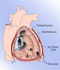 VENTRICULAR SEPTAL DEFECT.jpeg
