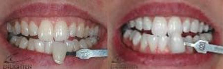 Teeth-whitening-5.jpg