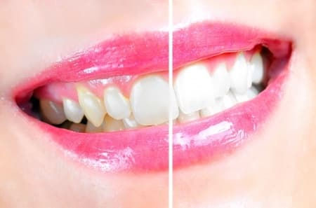 Teeth_whitening_1.jpg
