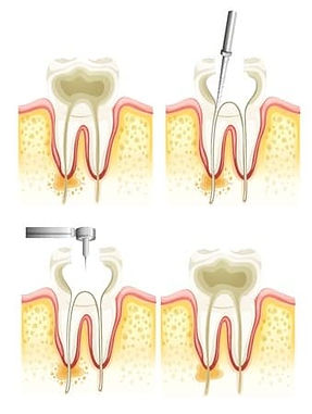 Root_canal_treatments_1.jpg