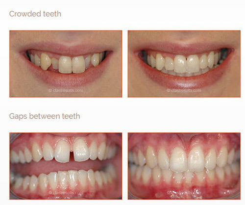 clearbraces (1).jpg