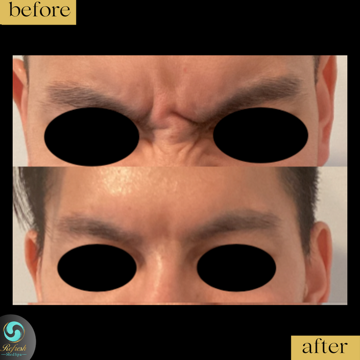 Xeomin glabella before_after