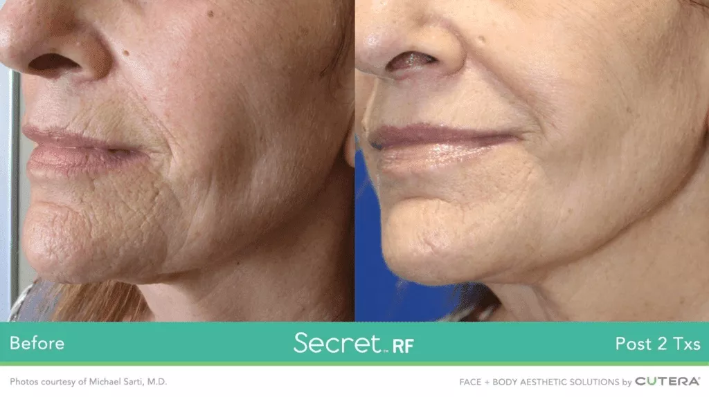 Before and After (2)