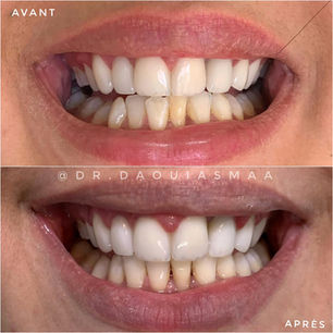 Avant après appareil dentaire Rabat - Orthodontie brackets - Centre Dentaire Daoui