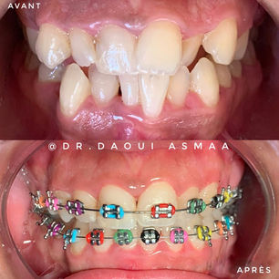 Avant après appareil dentaire avec ligatures colorées – orthodontie conventionnelle – Centre Dentaire Daoui Rabat 