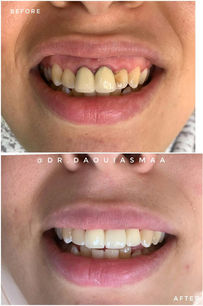 Bridge antéerieur zircone esthétique - Avant après prothèse - Centre Dentaire Daoui Rabat