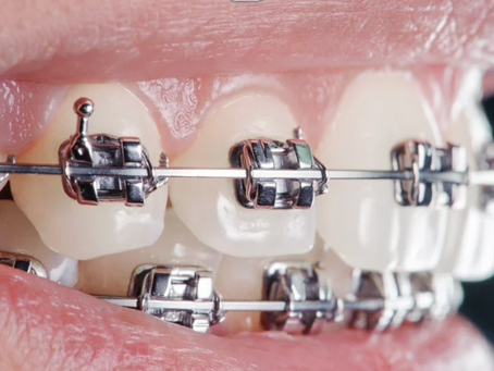 Zorgverzekeraars die een beugel vergoeden zonder wachttijd