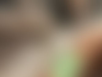 Tratamento de varizes sem cirurgia 