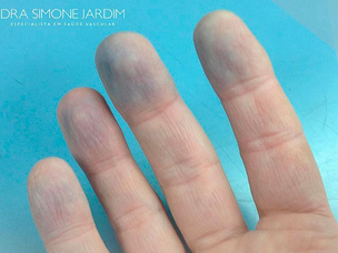 Você já ouviu falar da síndrome do dedo azul?