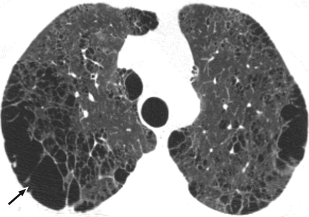 enfisema.gif