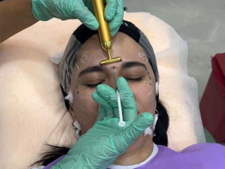 ¿Cuándo necesito Toxina botulÃnica? GuÃa rápida