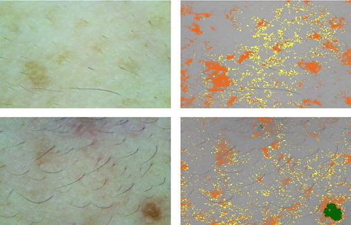 Skin Analysis