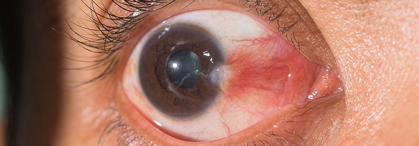 pterygium