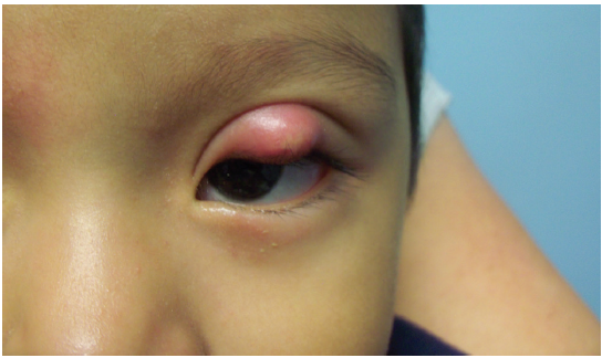 Chalazion3