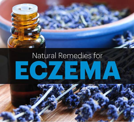 Exzema – Natural Remedies