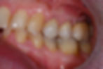 corone e abutment in zirconio (2).jpg